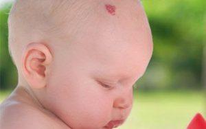 Birthmarks-newborns